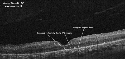 Cone-Rod Dystrophy an example of RPE atrophy due to cone-rod dystrophy