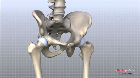 Hip Arthritis - Carolina Regional Orthopedics