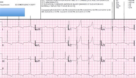 Dr. Smith's ECG Blog: Is this STEMI? LVH? Early Repolarization?