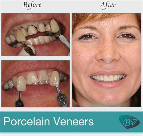 Step-by-Step Guide to Porcelain Veneer Procedure - West Hollywood Holistic and Cosmetic Dental Care