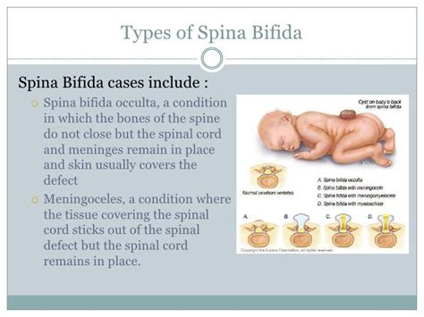 Spina Bifida Levels