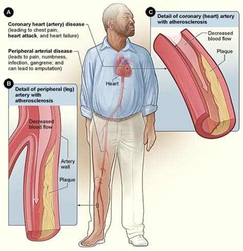 Coronary Artery Disease Diagnosis