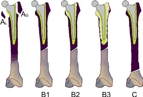 Vancouver classification of postoperative periprosthetic femur fractures. | Download Scientific ...