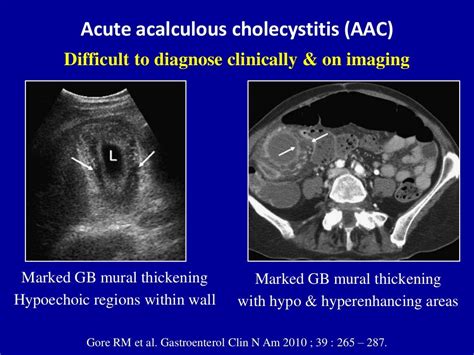 Ultrasound of acute & chronic cholecystitis