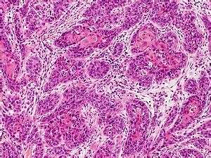 Squamous cell carcinoma of the skin - Libre Pathology