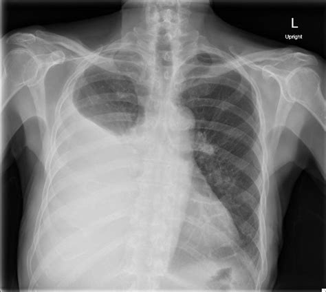 Large Right Pleural Effusion - JETem