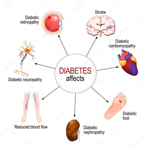 Diabetes Mellitus