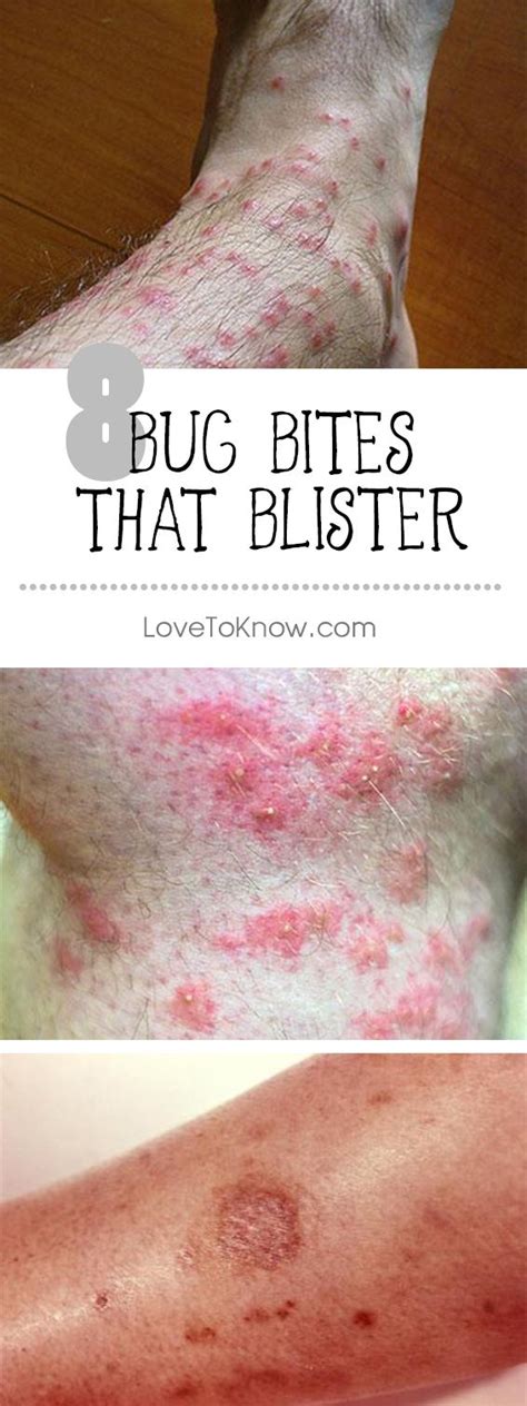 56 Best of How To Treat Mosquito Bite Blisters - insectza