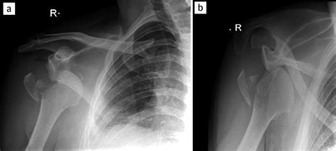 Right Shoulder Dislocation Icd 10 - Asking List