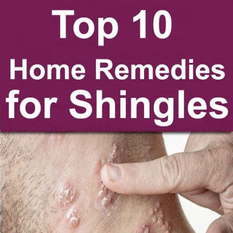 Top 10 Home Remedies for Shingles | Home remedies, Top 10 home remedies, Remedies