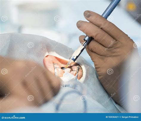 Crystalline Lens Replaceable Surgical Method Stock Image - Image of doctor, blindness: 92036421