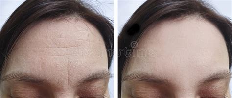 Female Forehead Wrinkles before Treatment Biorevitalization Stock Image - Image of correction ...