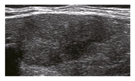 Adjustment of C-TIRADS classification of a thyroid nodule with early... | Download Scientific ...