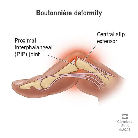 Boutonnière Deformacija: Kas Tai Yra, Priežastys Ir Gydymas - SFOMC