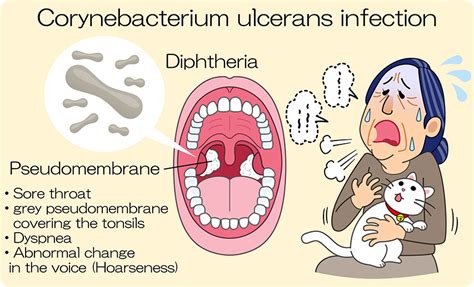 Diphtheria | Serum therapy