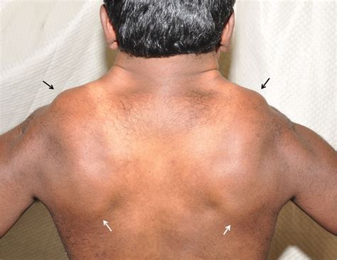 Scapular winging in a patient with Arnold–Chiari malformation type 1 and syringomyelia | BMJ ...