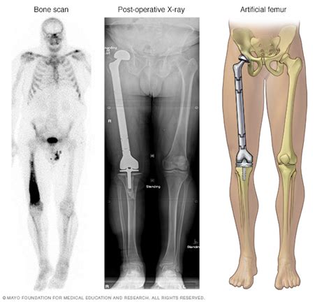 Chondrosarcoma - Diagnosis and treatment - Mayo Clinic