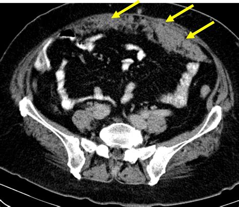 Omental cake from metastatic lung carcinoma – Radiology Cases