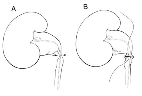 Laparoscopic Pyeloplasty | Johns Hopkins Medicine