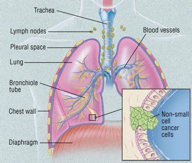 Adenocarcinoma of the lung Guide: Causes, Symptoms and Treatment Options