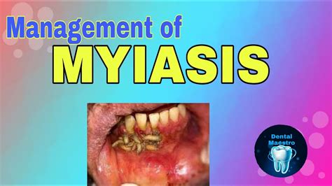 Myasis / Cutaneous Myiasis - Dermatology Advisor - Surface skin miases (myasis cutis ...