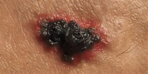 Melanoma : Get Any Unusual Bumps Or Lumps Checked | HuffPost UK