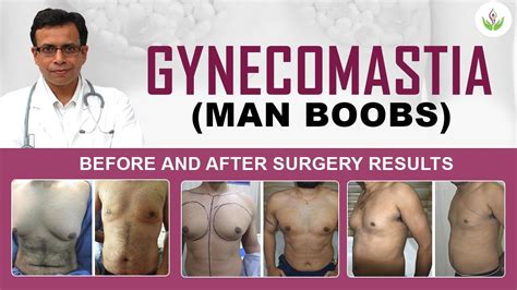 Gynecomastia (Man Boobs) Before and After Surgery Results Photos | Care ...