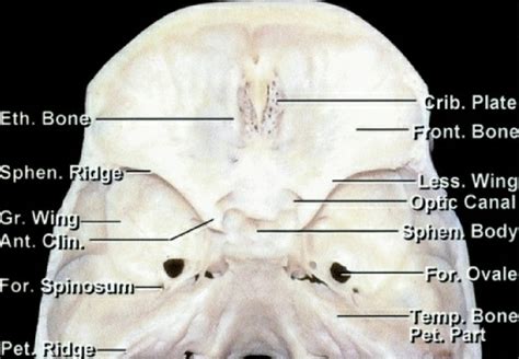 Figure 5 from Medial sphenoid wing meningioma. | Semantic Scholar