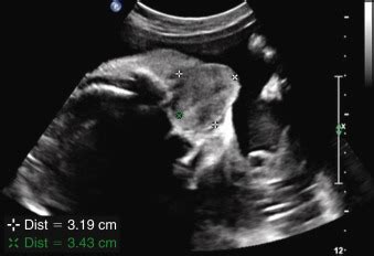 Beckwith-Wiedemann Syndrome | Radiology Key