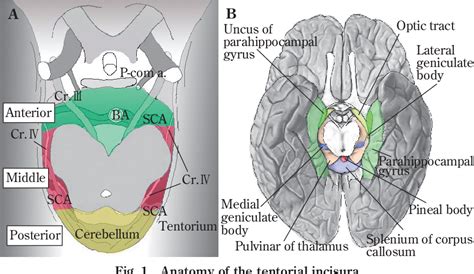 Figure 1 from Microsurgical Anatomy and Surgical Procedures for the Tentorial Incisura ...