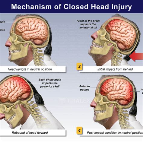 Mechanism of Closed Head Injury - TrialExhibits Inc.