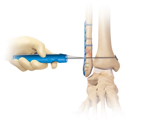 Arthrex - Syndesmosis TightRope® XP Implant System