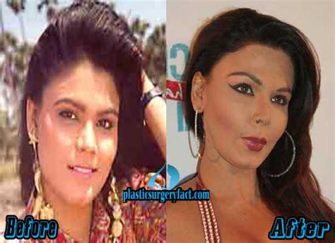 Rakhi Sawant Plastic Surgery Before and After