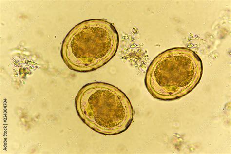 Roundworm In Stool