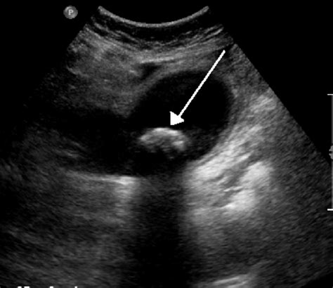 Gallbladder Problems: Gallstones | HubPages