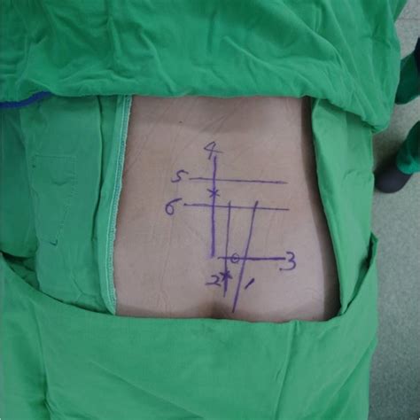 Skin landmarks on a patient’s back. 1, sacroiliac (SI) joint line; 2,... | Download Scientific ...