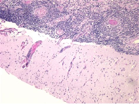 Inflammation infiltrating into the parenchyma of the brain and ...