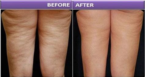 V Shape Results - Before and After - Petals Laser Lounge NYC Laser Spa | Health and nutrition ...