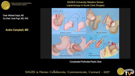 Modernizar Tacto fluir perforated duodenal ulcer Cuota de admisión Creyente Estados Unidos