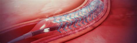 What Is A Better Option For Angioplasty? A Bare Metal Stent Or A Drug Eluded Stent? - Meril Life ...