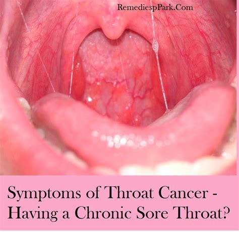 Cancer Types: Types Of Cancer In The Throat