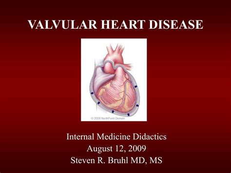 Valvular Heart Disease Ppt - Captions Trending Update