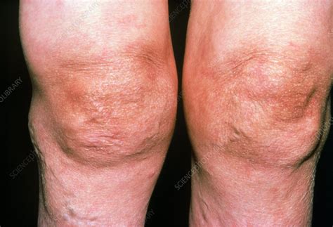 Rheumatoid arthritis in knees - Stock Image M110/0193 - Science Photo Library