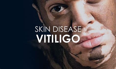 Vitiligo Skin Disease: Causes, Symptoms & Treatments - Premier Clinic