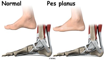 Congenital Flatfoot - Midwest Bone and Joint Institute - Illinois