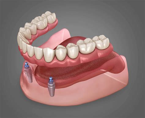 Protocolo overdenture - Kion Dental Technology