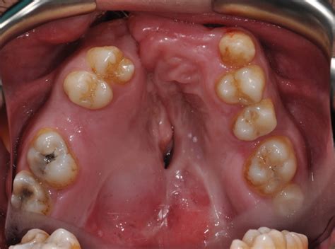 Tooth Abscess Draining Through Fistula - Best Drain Photos Primagem.Org