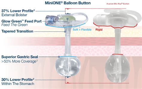 MiniONE® Balloon | Applied Medical Technology