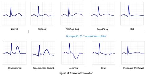 Step 8 of Interpretation of ECG-T-wave – medtigo