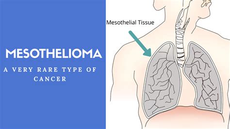 Mesothelioma: A Rare Type Of Aggressive Cancer - DrugsBank